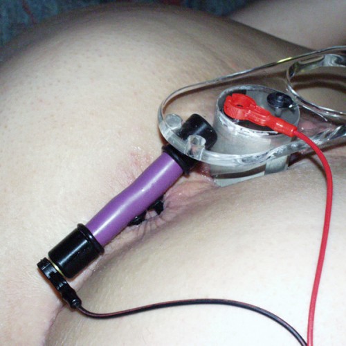 Anal Electrodes 34